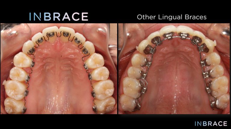 Inbrace Nellie Gail Orthodontics