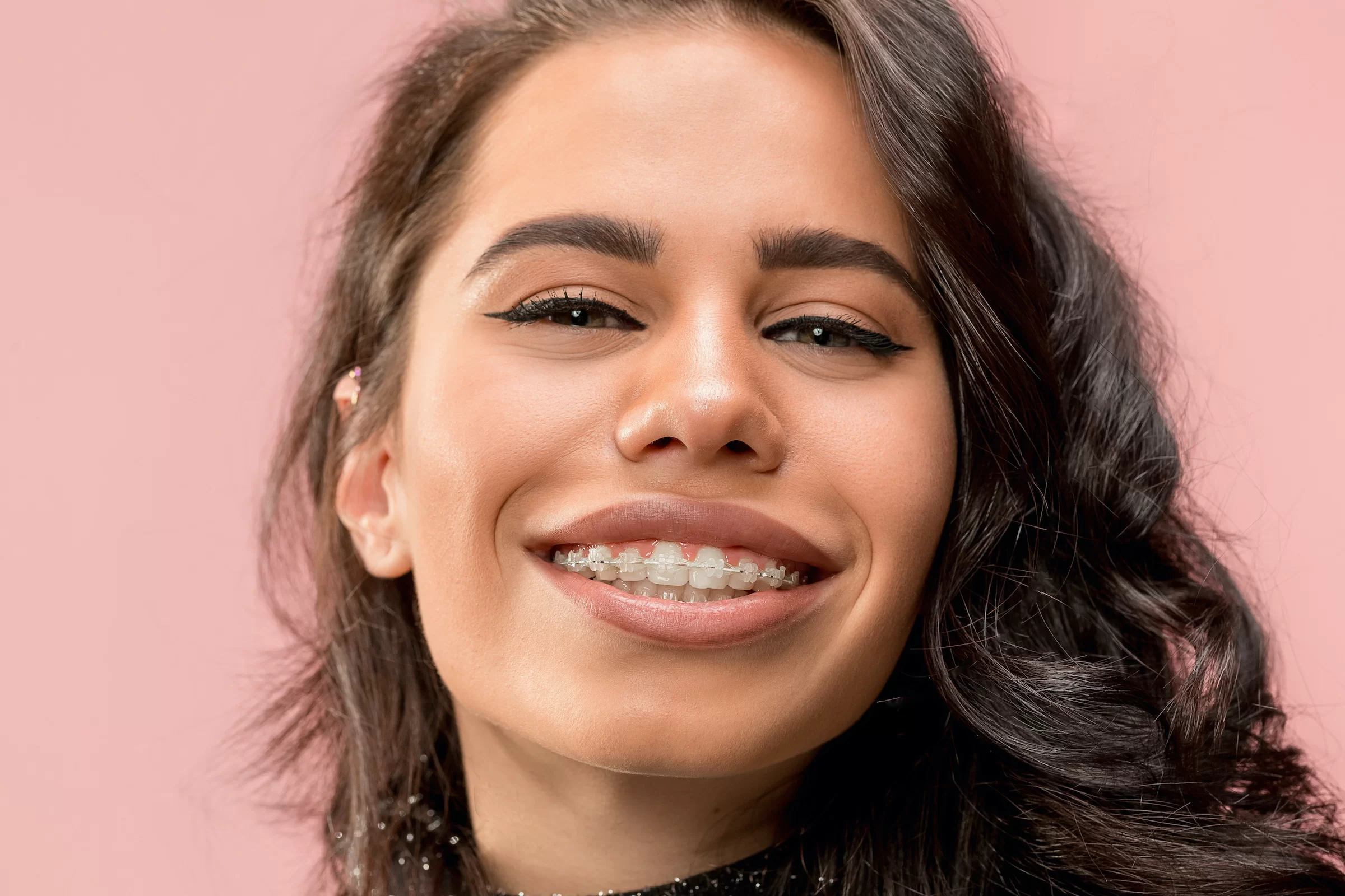 Nellie Gail Orthodontics clear braces treatment in Aliso Viejo and Laguna Niguel, Orange County